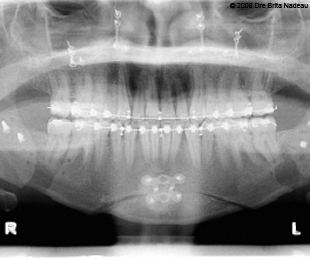 Marie-Hélène Cyr - Panoramic X-ray after my orthognathic surgeries (April 22, 2008)